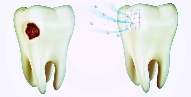 Деминерализация зуба