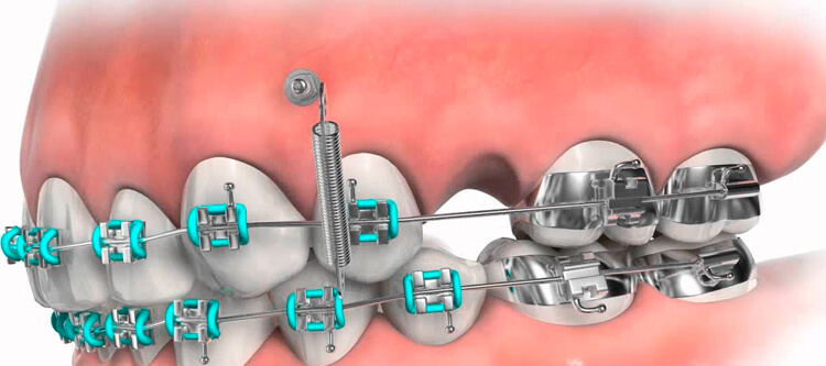Микроимпланты в ортодонтии