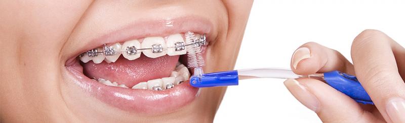 Гигиена зубов при лечении на брекетах