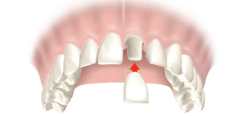 Удлинение коронки зуба