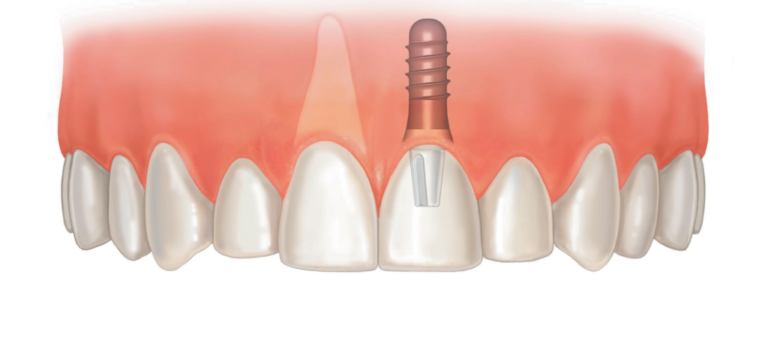 Импланты на передние зубы